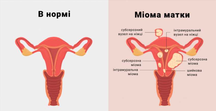 Чого категорично не можна робити при міомі матки